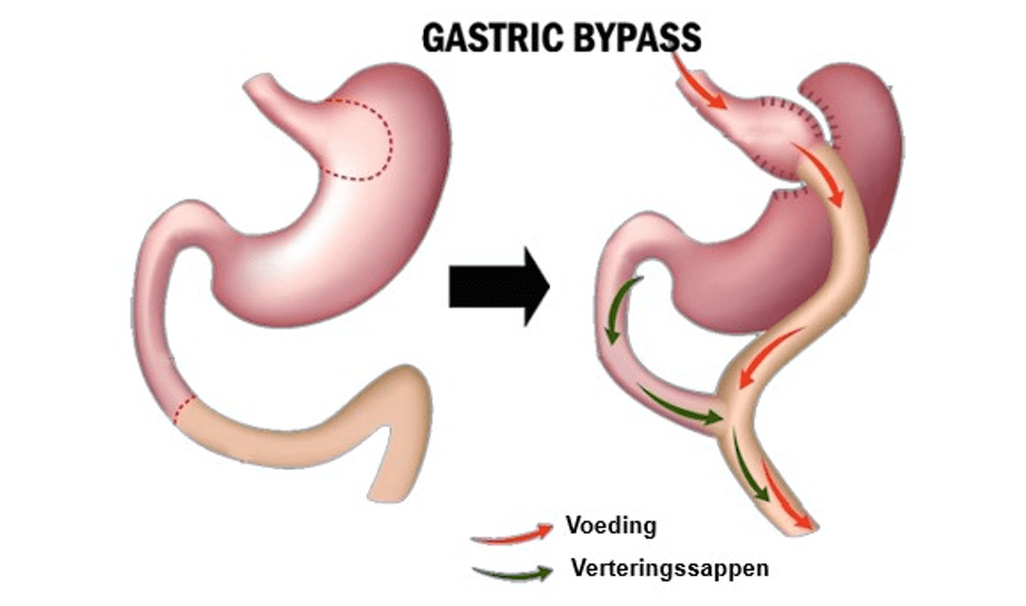 Maagverkleining Gastric Bypass Care Kliniek